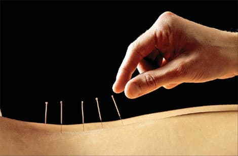 العلاج بالإبر الصينية